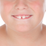 Reduce Gap between Teeth Naturally